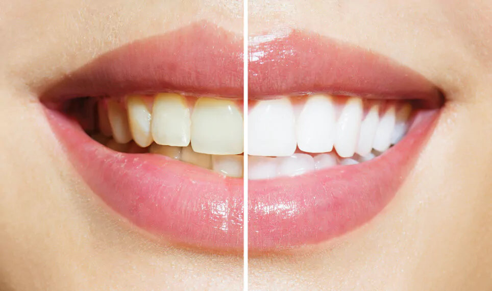 Theeth-Whitening